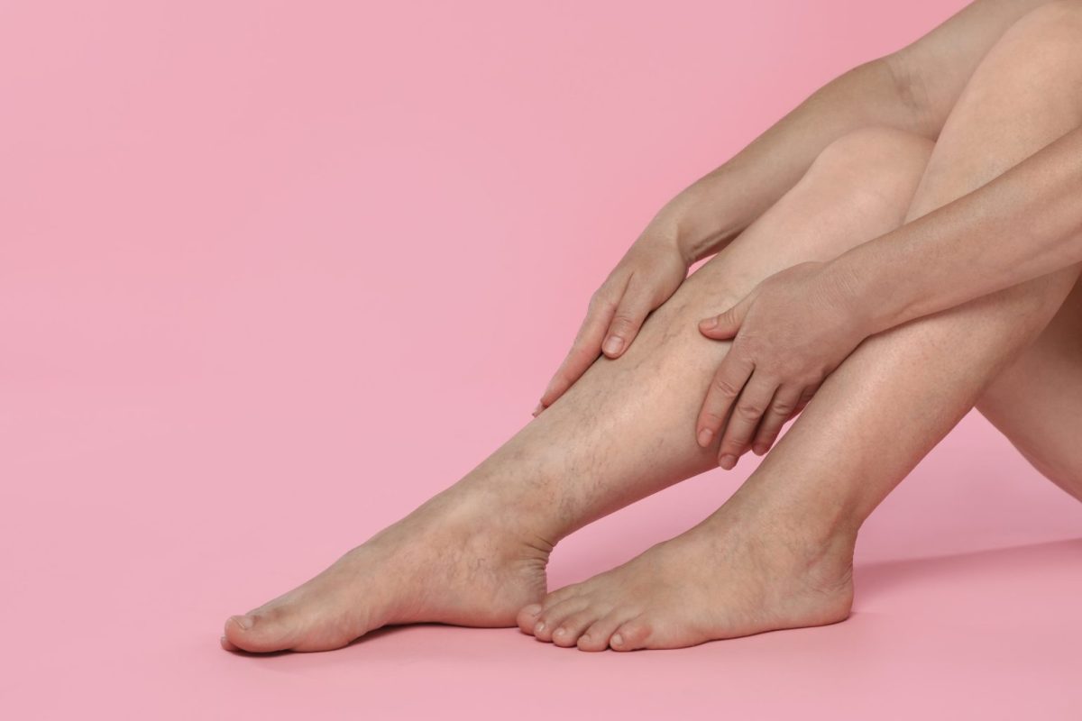 Κιρσοί και ευρυαγγείες: Το Νο1 αιθέριο έλαιο που βοηθά στη φλεβική υγεία